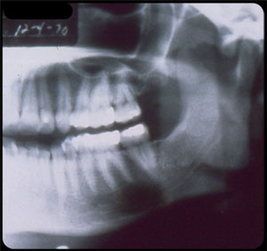 Mandibular radiograph