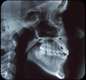 Normal Radiographic Anatomy Of Mandibular And Maxillary Periapical